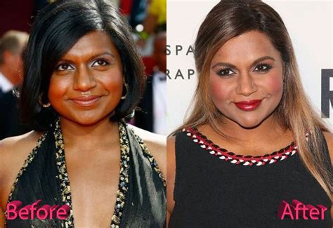 mindy kaling plastic surgery|Mindy Kaling, Before and After